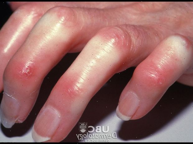 Esclerodermia e a Doença Celíaca